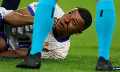 Mbappé se fracturó la nariz